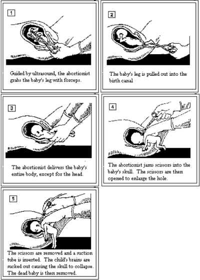 partial birth diagram